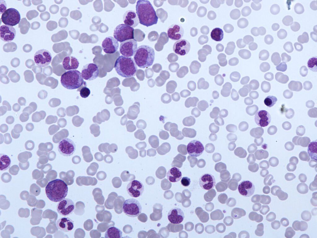 leucemia mielomonocitica cronica