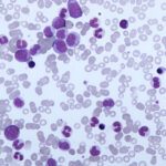 leucemia mielomonocitica cronica